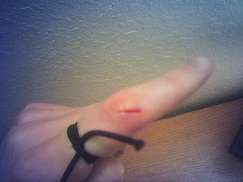 Finger Cut